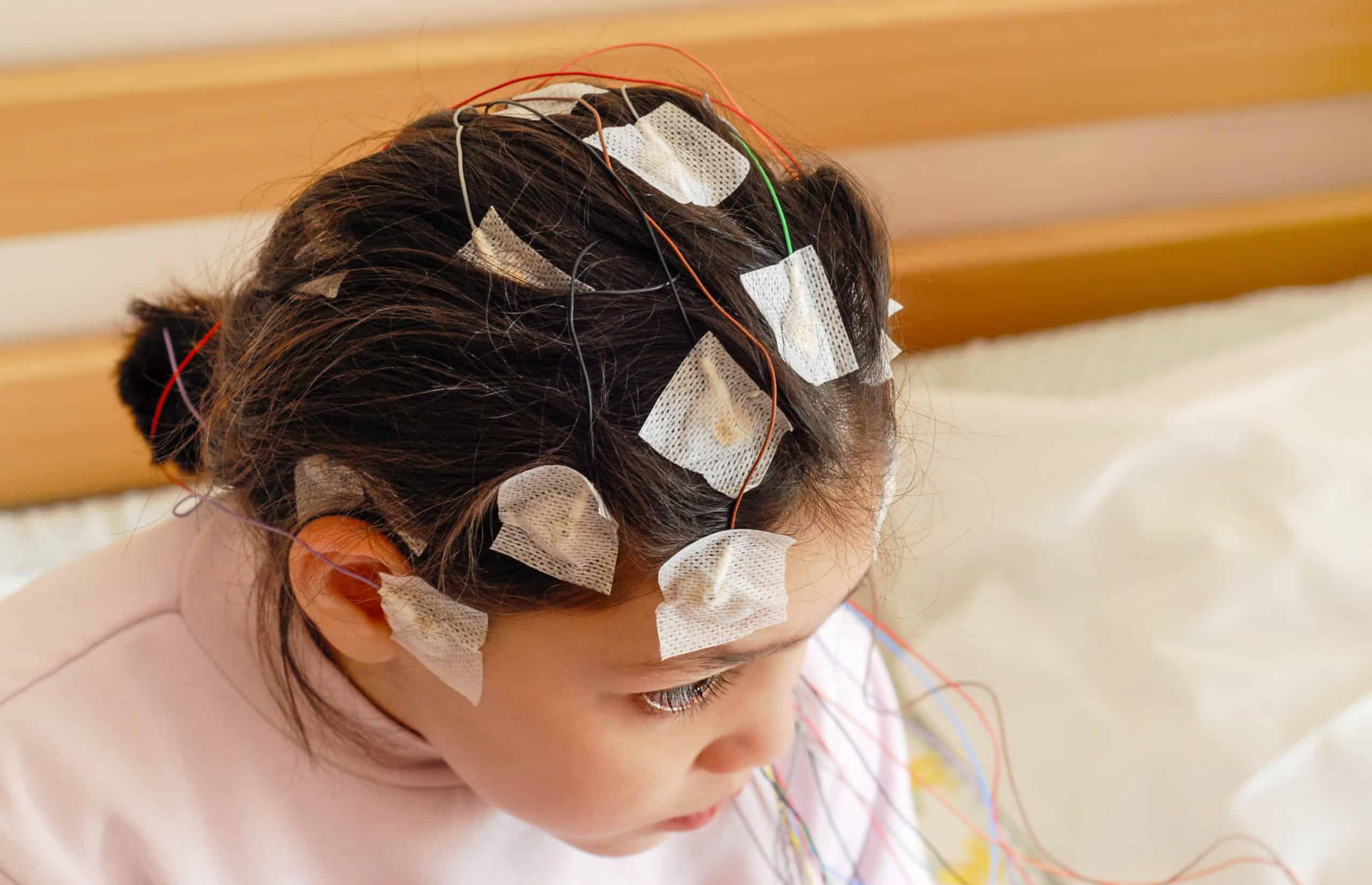 Girl with EEG electrodes attached to her head for medical test Girl with EEG electrodes attached to her head